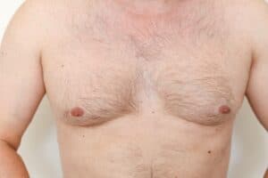 Gynecomastia Candidates Nashville