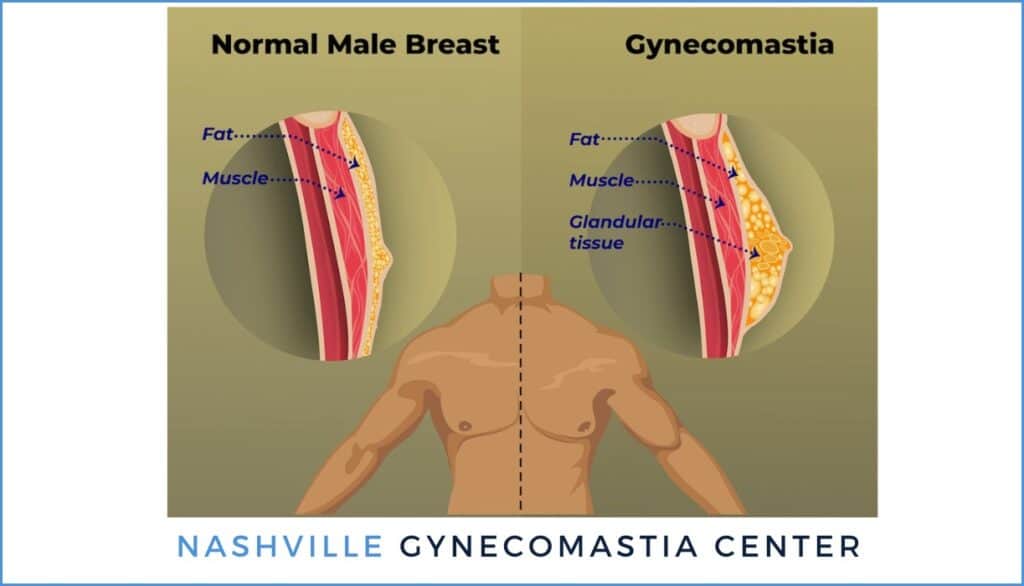 Gynecomastia Nashville