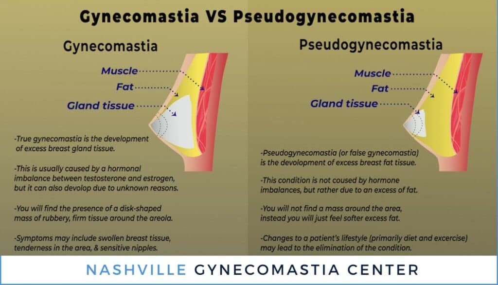 Pseudogynecomastia Surgery Nashville