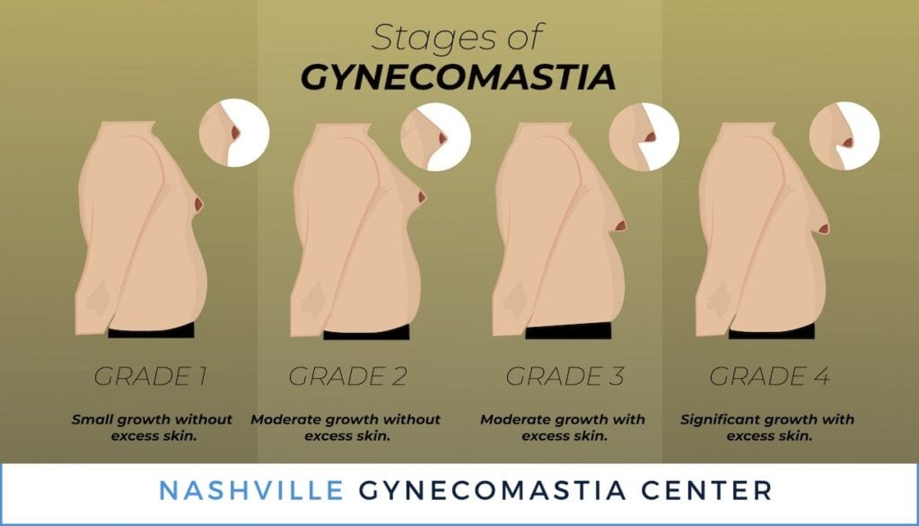 Stages Grades of Gynecomastia